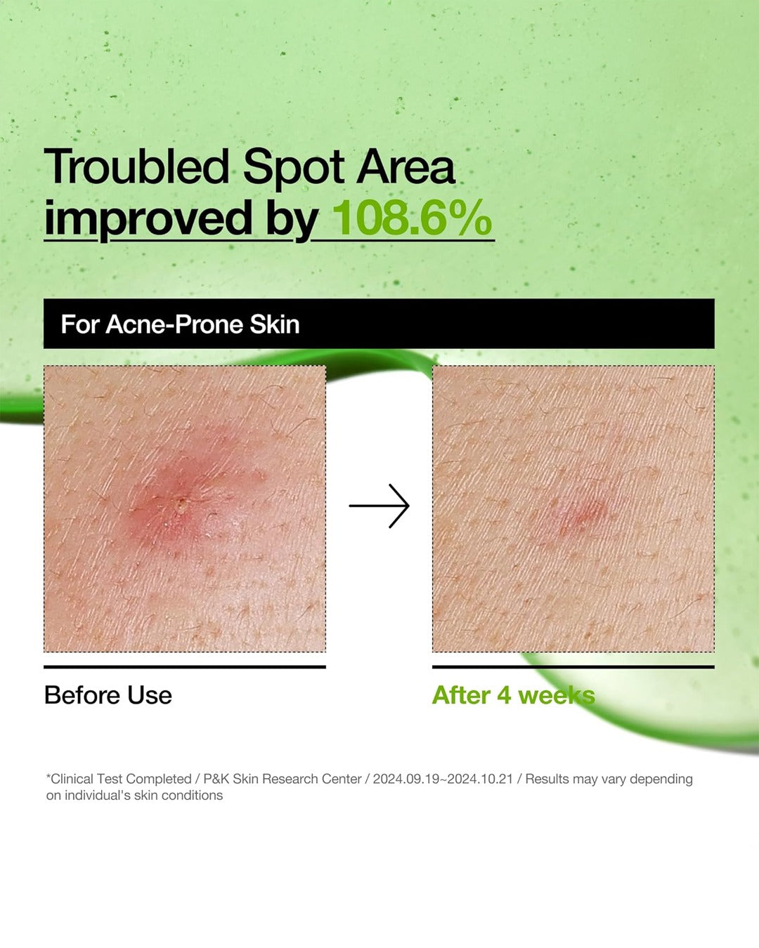 Azelaic Acid 10 Hyaluron Redness Soothing Serum